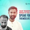 Hair Transplant Results