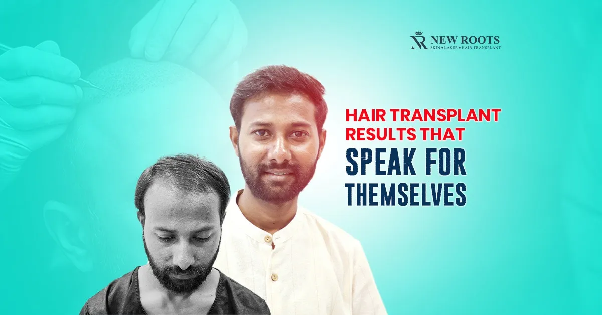 Hair Transplant Results