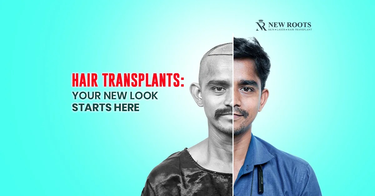 Hair Transplants