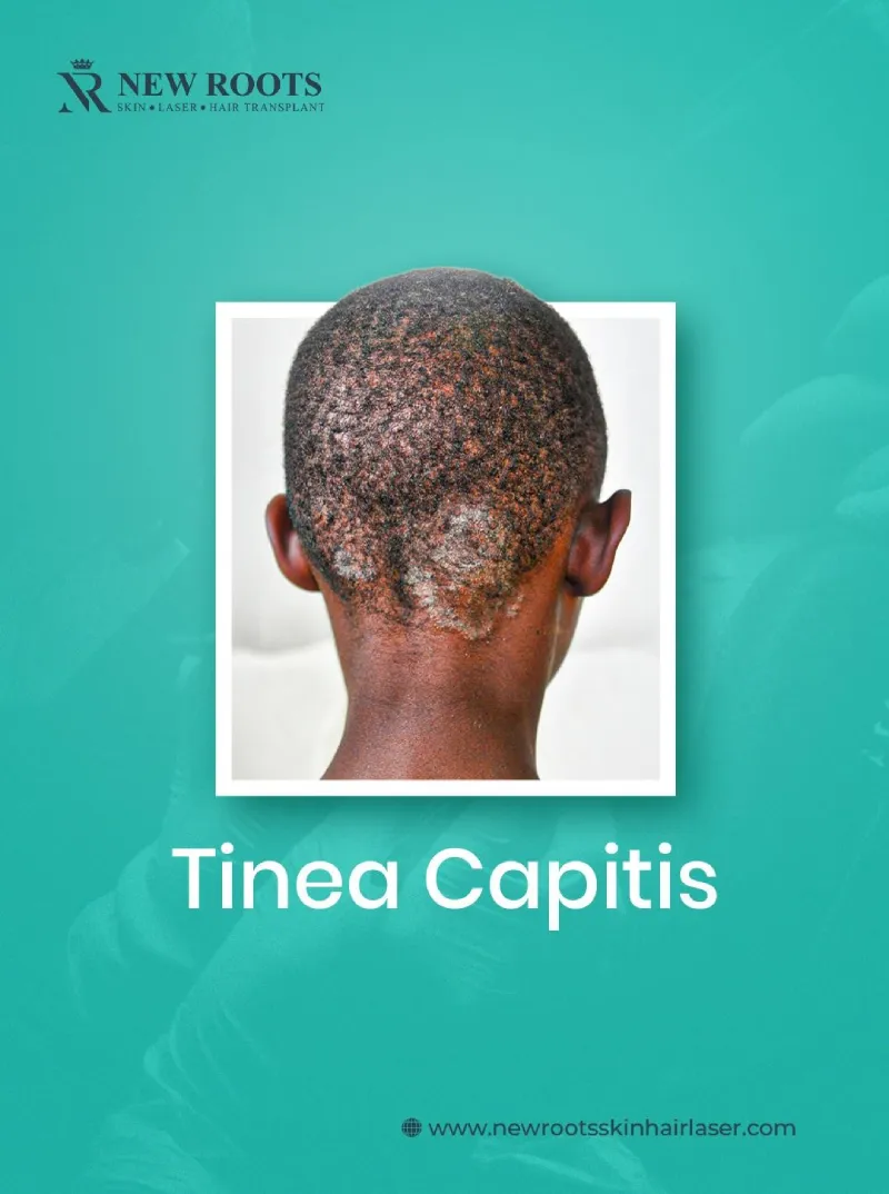 Can Dandruff Cause Hair Loss