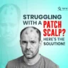 patchy scalp problems