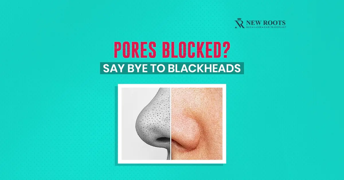 blackheads, pore-clogging