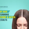 PRP Hair Treatment Before and After