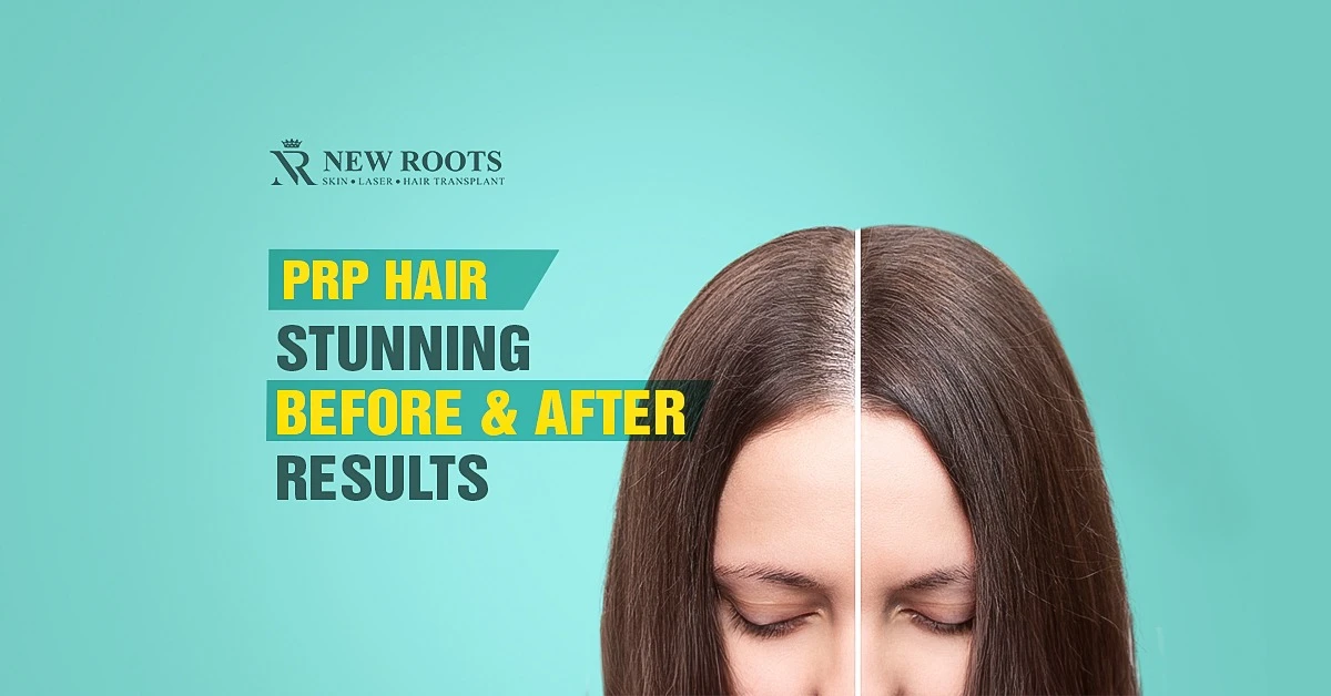 PRP Hair Treatment Before and After