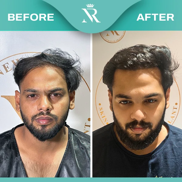 Sapphire FUE Hair Transplant - Result (Sep 2025)