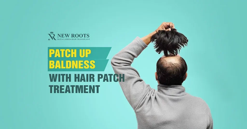 What is hair patch treatment