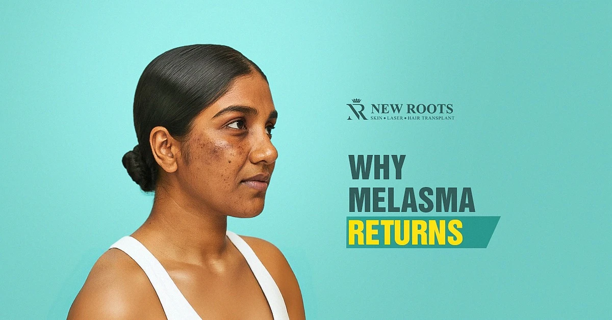 melasma recurrence, city skin