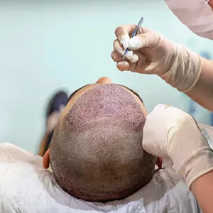 Hair Transplant