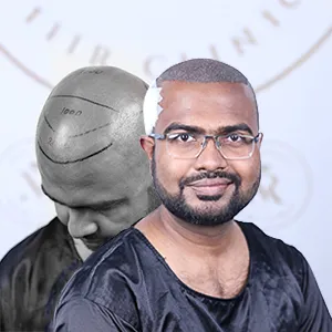 FUE Hair Transplant