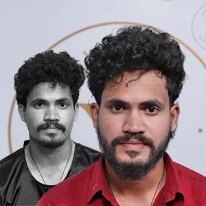 Beard Hair Transplant