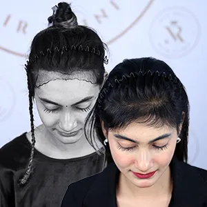 Female Hair Transplant