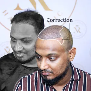 Hair Transplant Correction