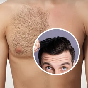 Body Hair Transplant