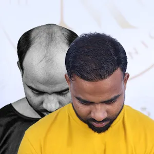 Bio-Sapphire Hair Transplant
