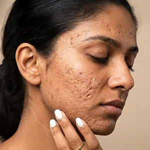 Acne scar