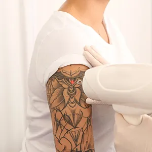 Laser tattoo Reduction