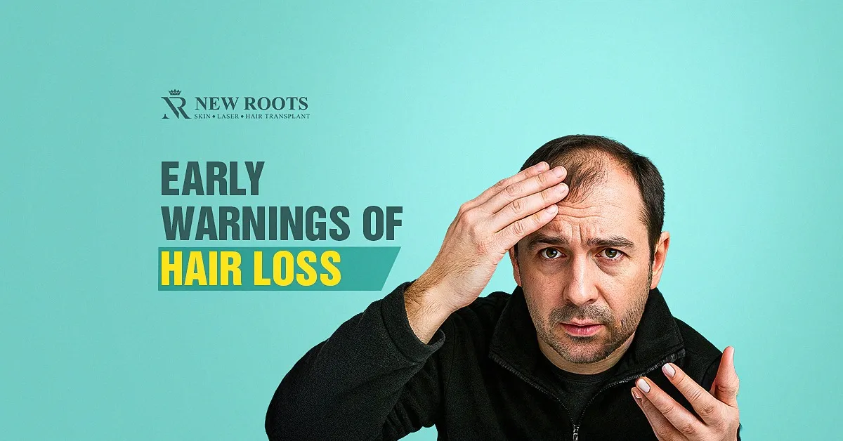 early signs of balding male