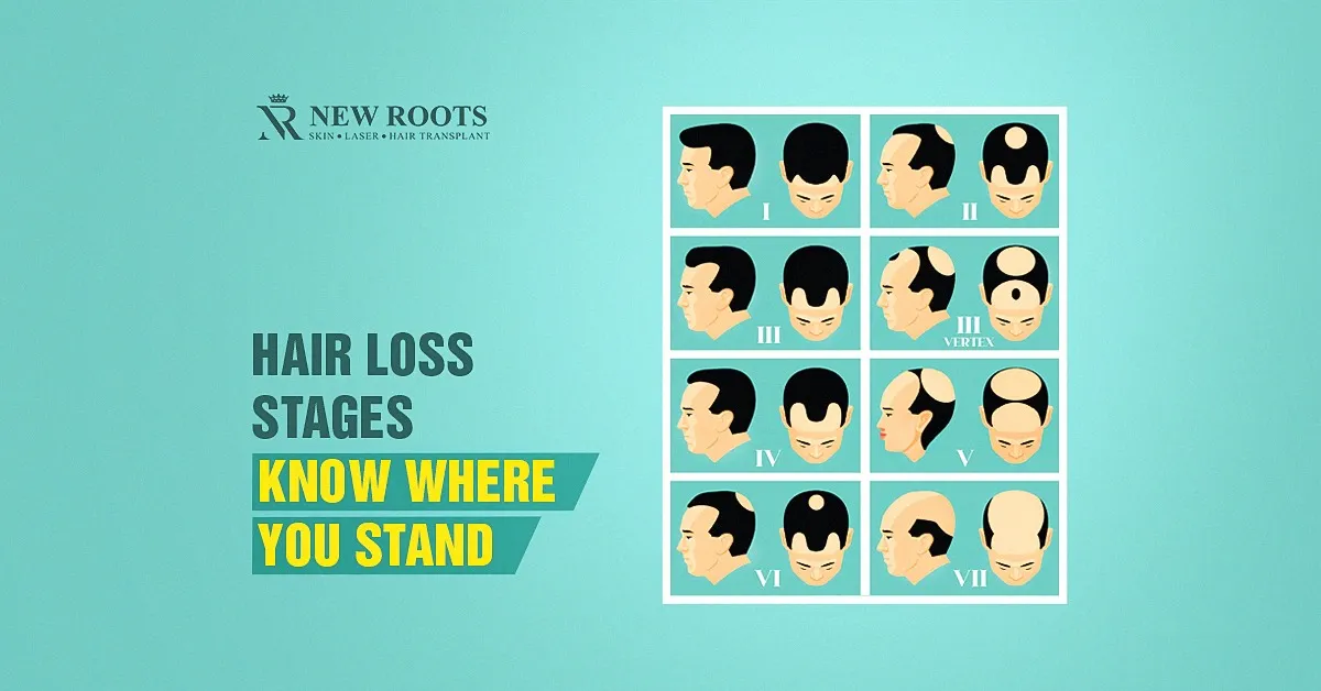 hair loss stages