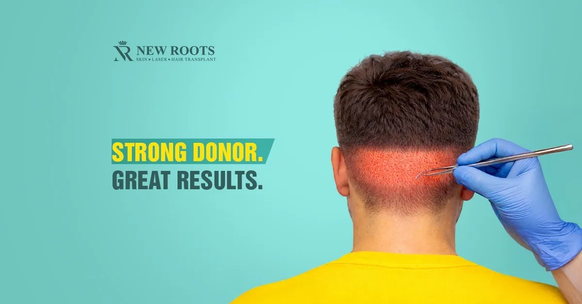 hair transplant donor area