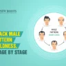male pattern baldness stages