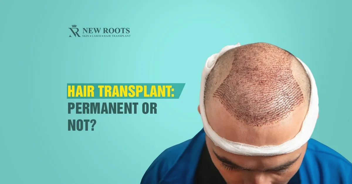 Is a hair transplant permanent