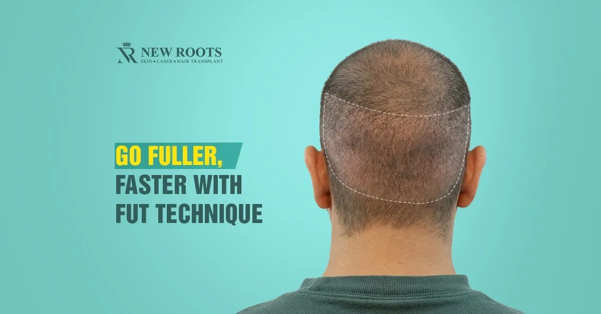fut hair transplant