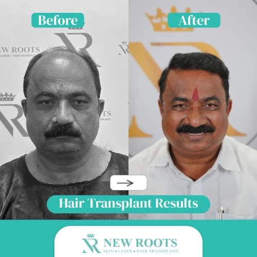 Hair Transplant Result