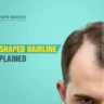 What is a M-Shaped Hairline Male