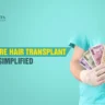 hair transplant cost in Bangalore