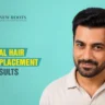 Real Hair Replacement Results final