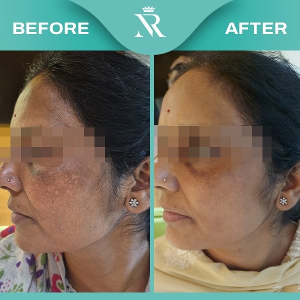 Melasma Result