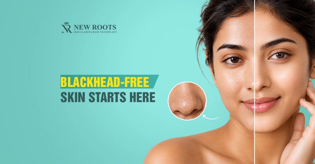 beat-blackheads-in-humid-heat-right-products-to-use