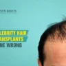 celebrity hair transplant gone wrong