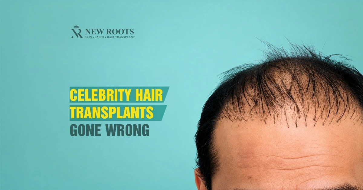 celebrity hair transplant gone wrong