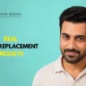 hair replacement before and after