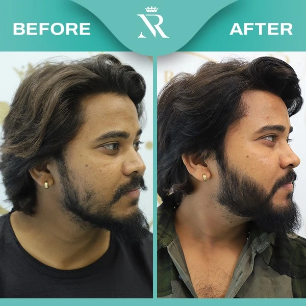 Beard Hair Transplant