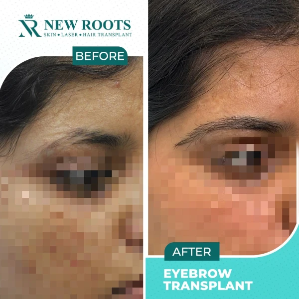 Eyebrow Hair Transplant