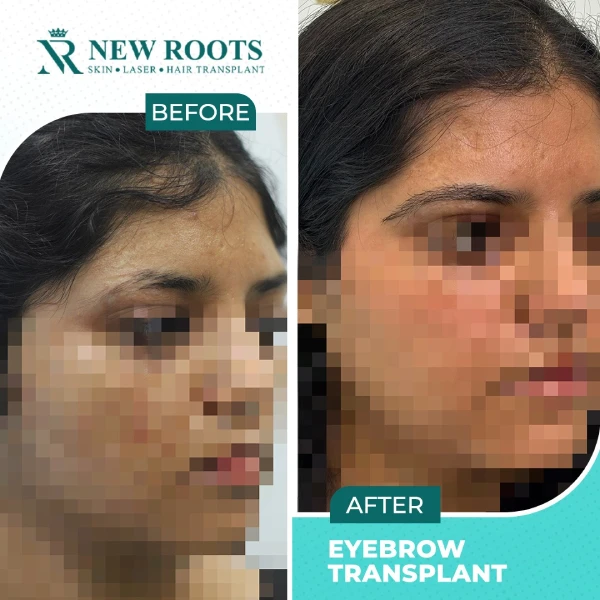 Eyebrow Hair Transplant