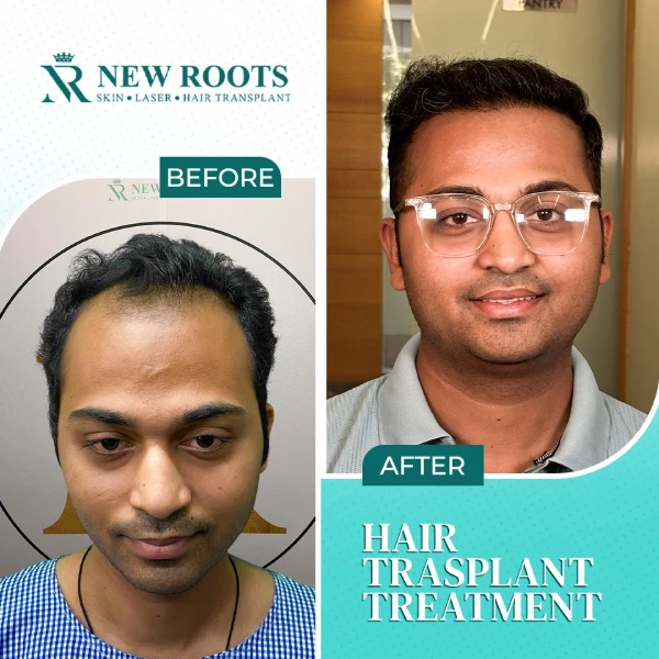 FUE Hair Transplant