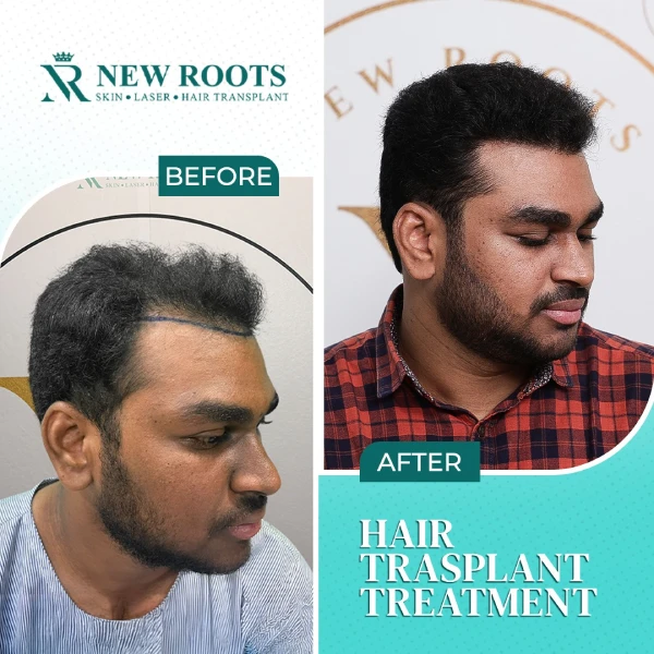 FUE Hair Transplant