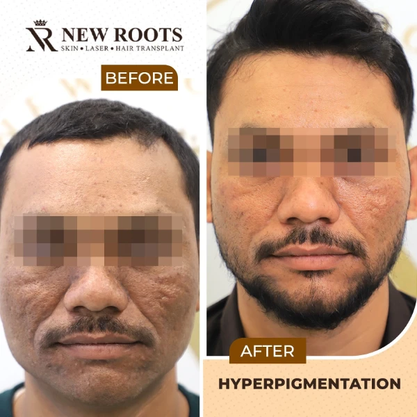 Hyperpigmentation Result 01 FS - July 2026