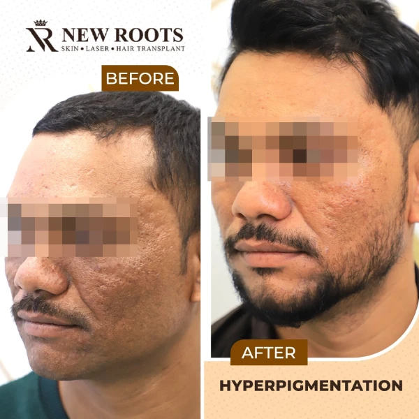 Hyperpigmentation Result 01 LS - July 2026