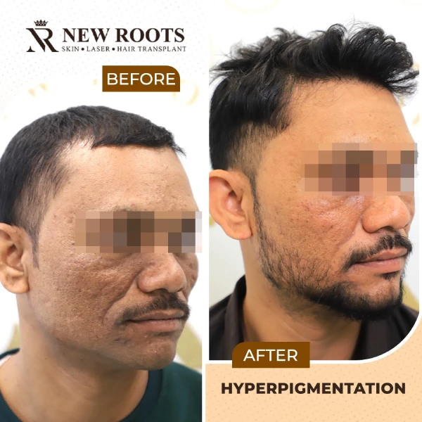 Hyperpigmentation Result 01 RS - July 2026