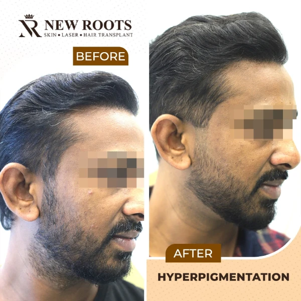 Hyperpigmentation Result 02 RS - July 2026