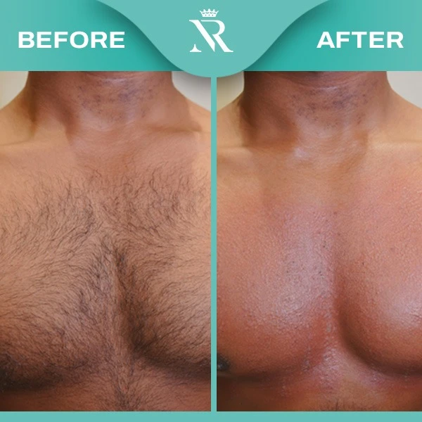 Laser Hair Removal