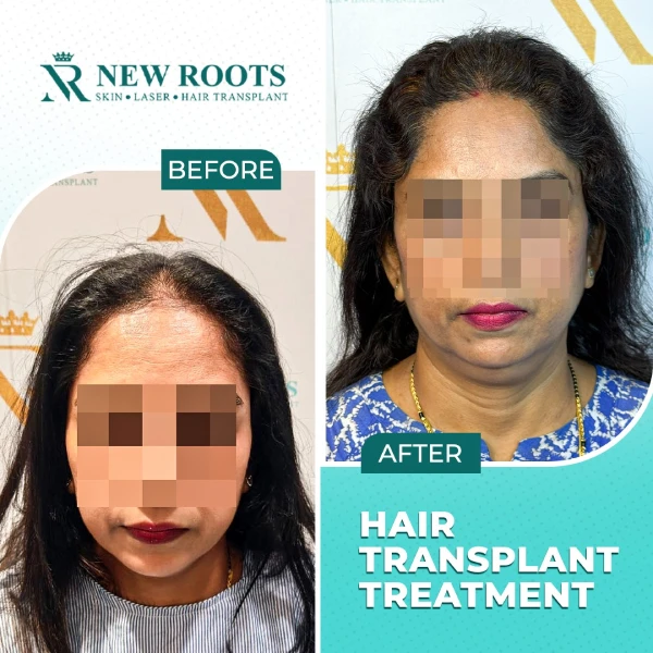 Female Hair Transplant - Aug 2026