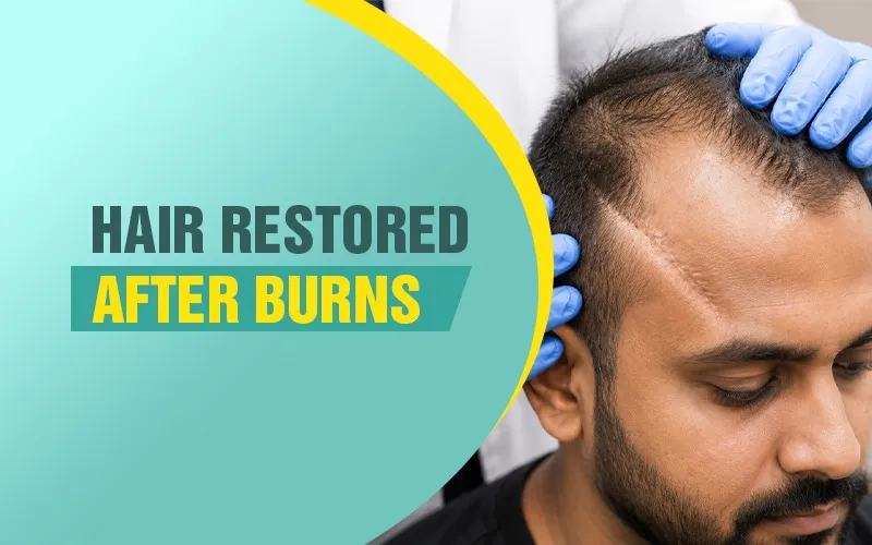 Burn Scar Hair Transplant