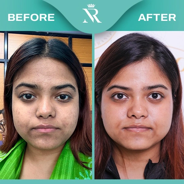 Acne Treatement - Oct 2026