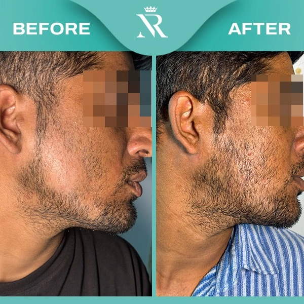 Alopecia Areata