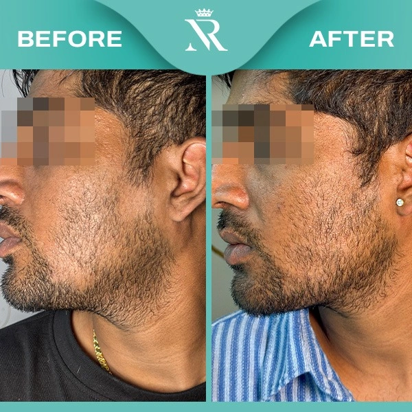 Alopecia Areata